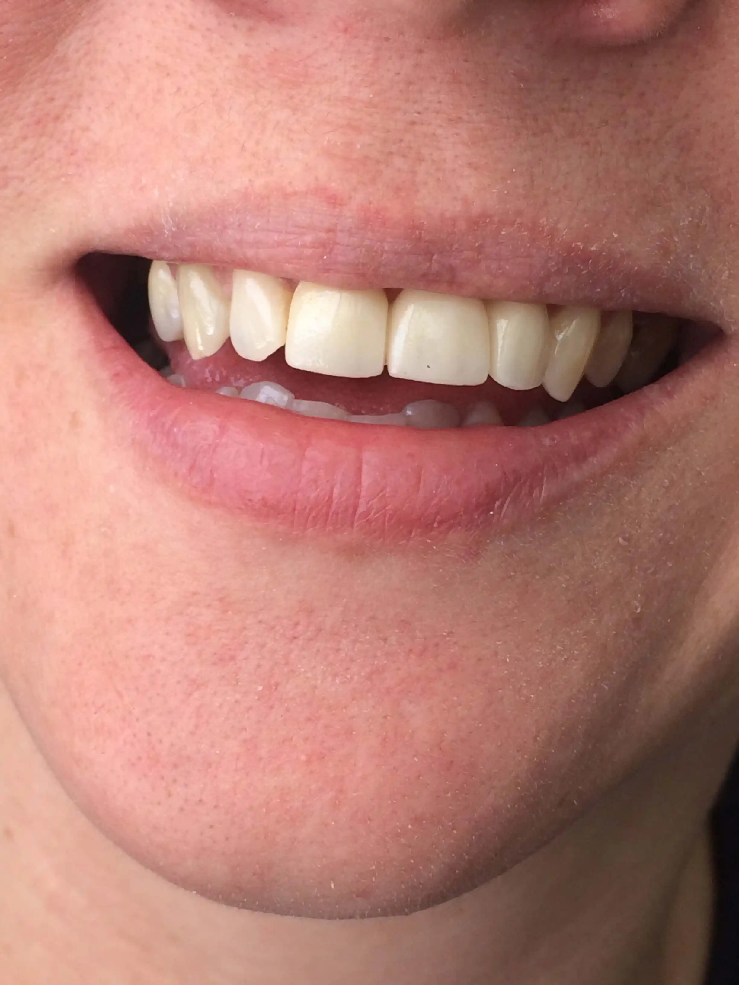 After: Emax ceramic crowns